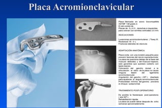 Placa Acromionclavicular
 