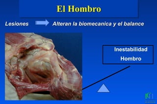 El Hombro
Lesiones Alteran la biomecanica y el balance
Inestabilidad
Hombro
 