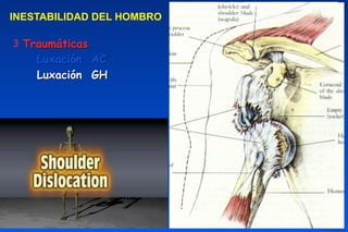 3 Traumáticas
Luxación AC
Luxación GH
INESTABILIDAD DEL HOMBRO
 