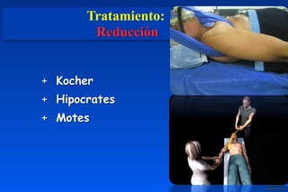 Tratamiento:
Reducción
+ Kocher
+ Hipocrates
+ Motes
 