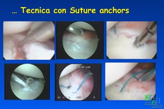 … Tecnica con Suture anchors
 