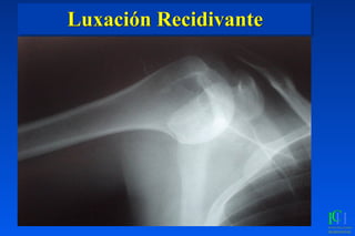 Luxación Recidivante
 