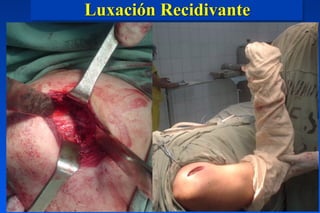 Luxación Recidivante
 