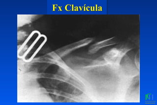 Fx Clavícula
 