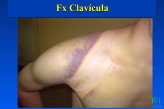 Fx Clavícula
 