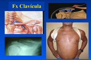 Fx Clavícula
 