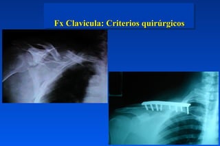 Fx Clavicula: Criterios quirúrgicos
 