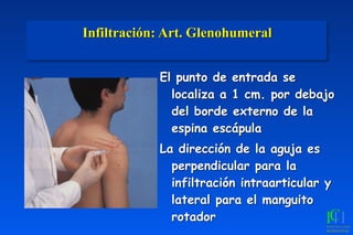 Infiltración: Art. Glenohumeral 
El punto de entrada se
localiza a 1 cm. por debajo
del borde externo de la
espina escápula
La dirección de la aguja es
perpendicular para la
infiltración intraarticular y
lateral para el manguito
rotador
 