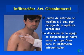 Infiltración: Art. Glenohumeral
El punto de entrada se
localiza a 1 cm. por
debajo de la apófisis
coracoides
La dirección de la aguja
es perpendicular hasta
notar un tope óseo
para la infiltración
intraarticular
 