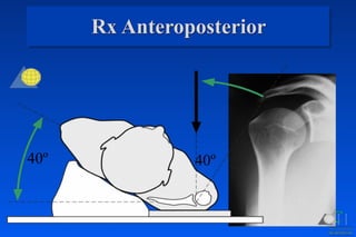 Rx Anteroposterior
40º 40º
 