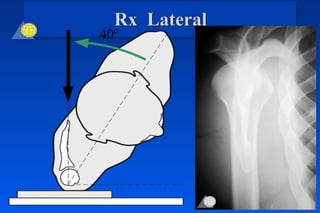 Rx Lateral
40º
 