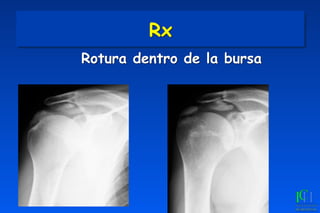 Rx
Rotura dentro de la bursa
 