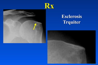 Rx
Esclerosis
Trquiter
 