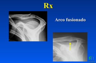 Rx
Arco fusionado
 