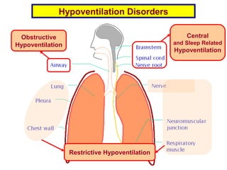 Hypoventilation Disorders
Obstructive
Hypoventilation
Central
and Sleep Related
Hypoventilation
Restrictive Hypoventilation
 