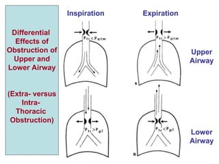 Inspiration Expiration
Upper
Airway
Lower
Airway
Differential
Effects of
Obstruction of
Upper and
Lower Airway
(Extra- versus
Intra-
Thoracic
Obstruction)
 
