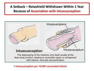 A Setback – Rotashield Withdrawn Within 1 Year
Because of Association with Intussusception
1 intussusception per 10,000 vaccinated infants
 