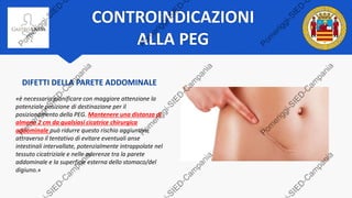 CONTROINDICAZIONI
ALLA PEG
DIFETTI DELLA PARETE ADDOMINALE
«è necessario pianificare con maggiore attenzione la
potenziale posizione di destinazione per il
posizionamento della PEG. Mantenere una distanza di
almeno 2 cm da qualsiasi cicatrice chirurgica
addominale può ridurre questo rischio aggiuntivo,
attraverso il tentativo di evitare eventuali anse
intestinali intervallate, potenzialmente intrappolate nel
tessuto cicatriziale e nelle aderenze tra la parete
addominale e la superficie esterna dello stomaco/del
digiuno.»
 