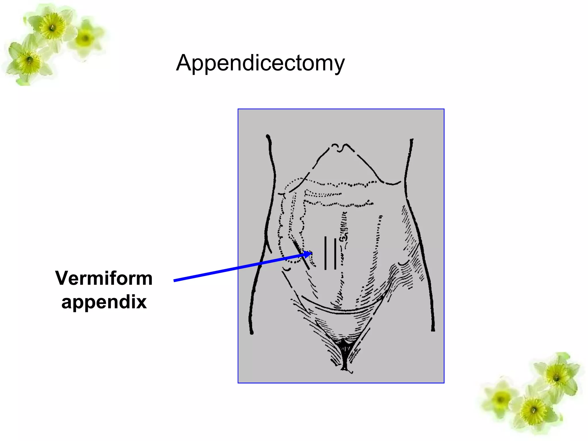 Appendicectomy
Vermiform
appendix
 