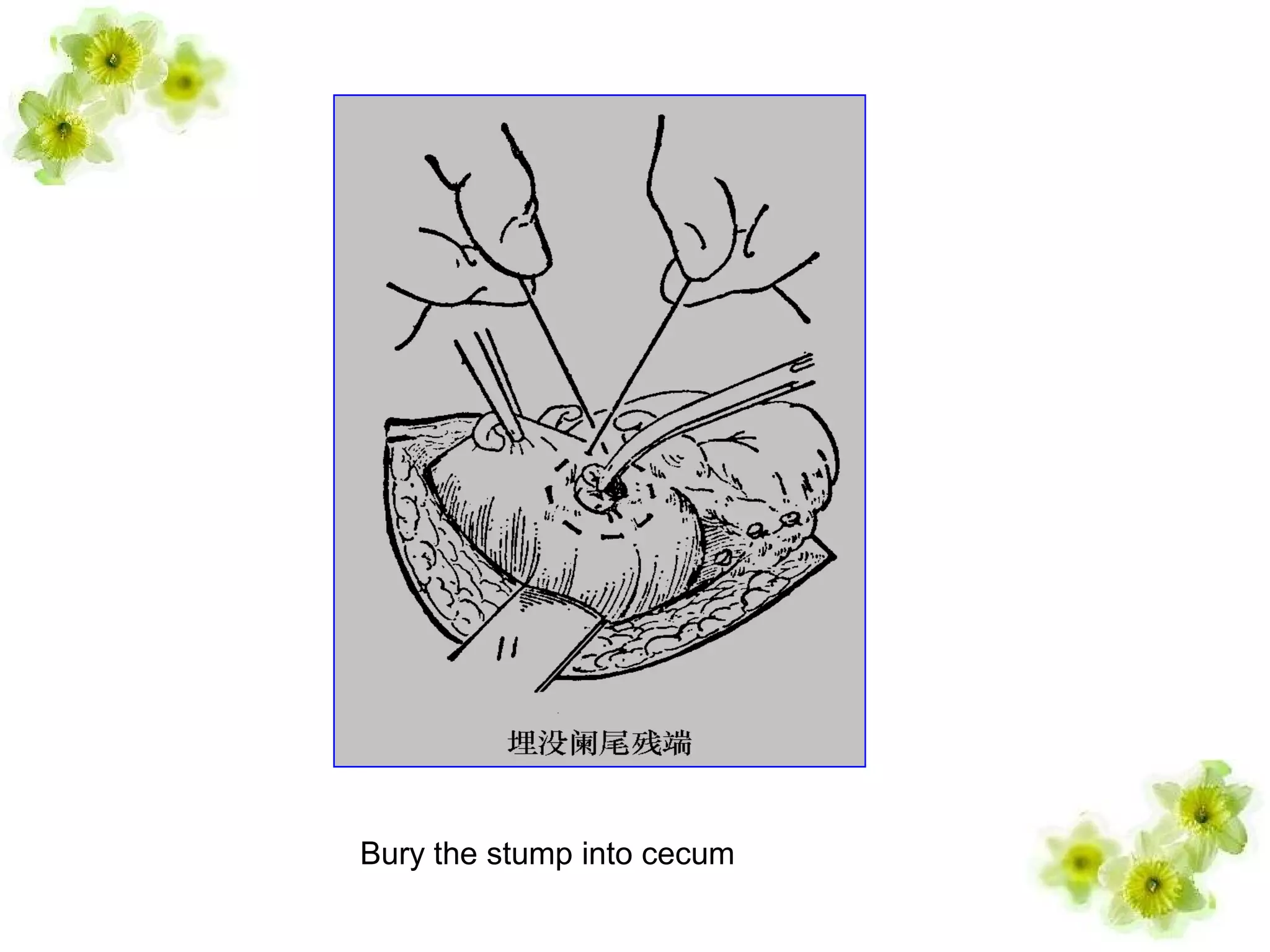 Bury the stump into cecum
 