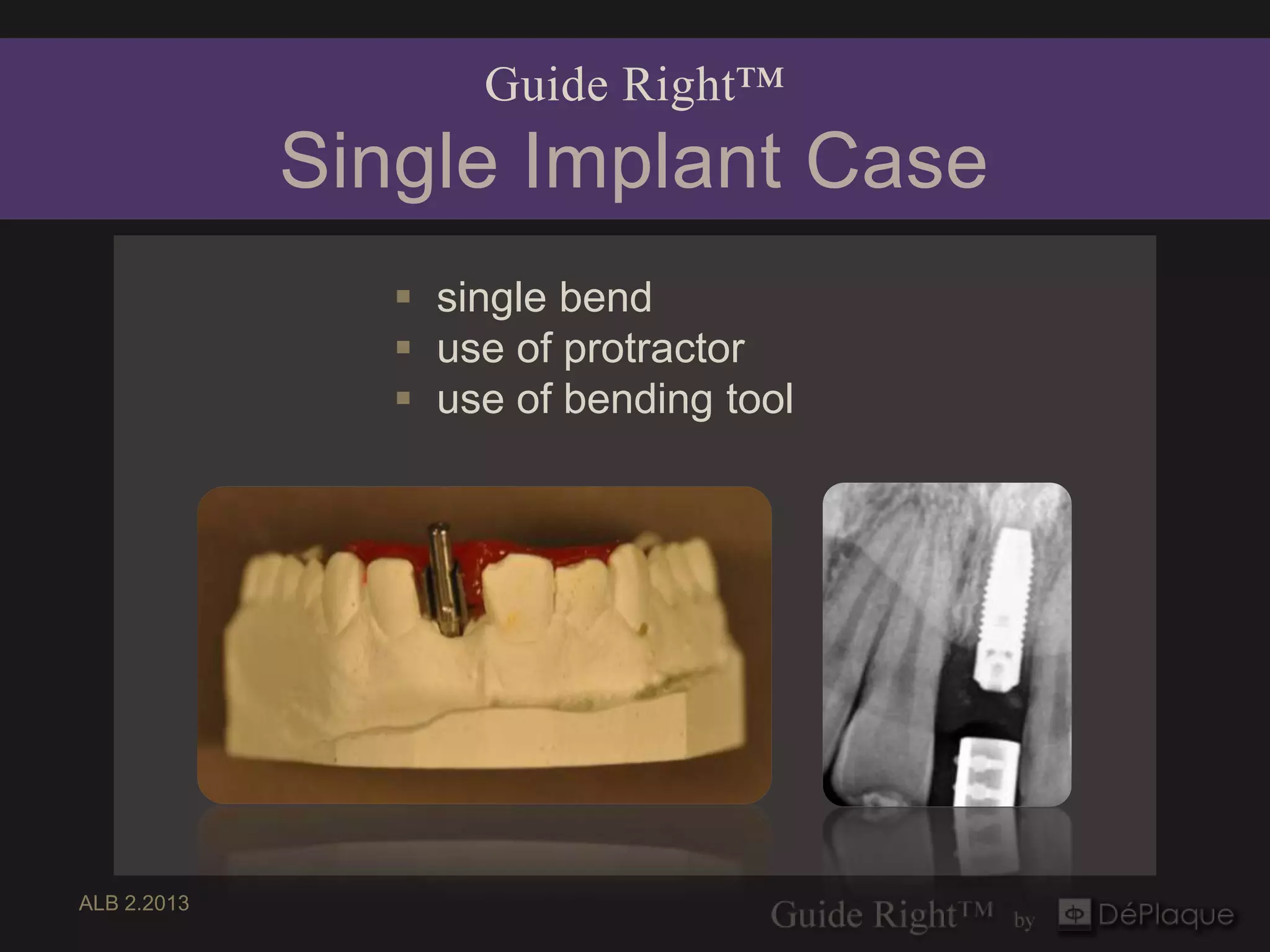Guide Right™
             Single Implant Case
                 single bend
                 use of protractor
                 use of bending tool




ALB 2.2013
 