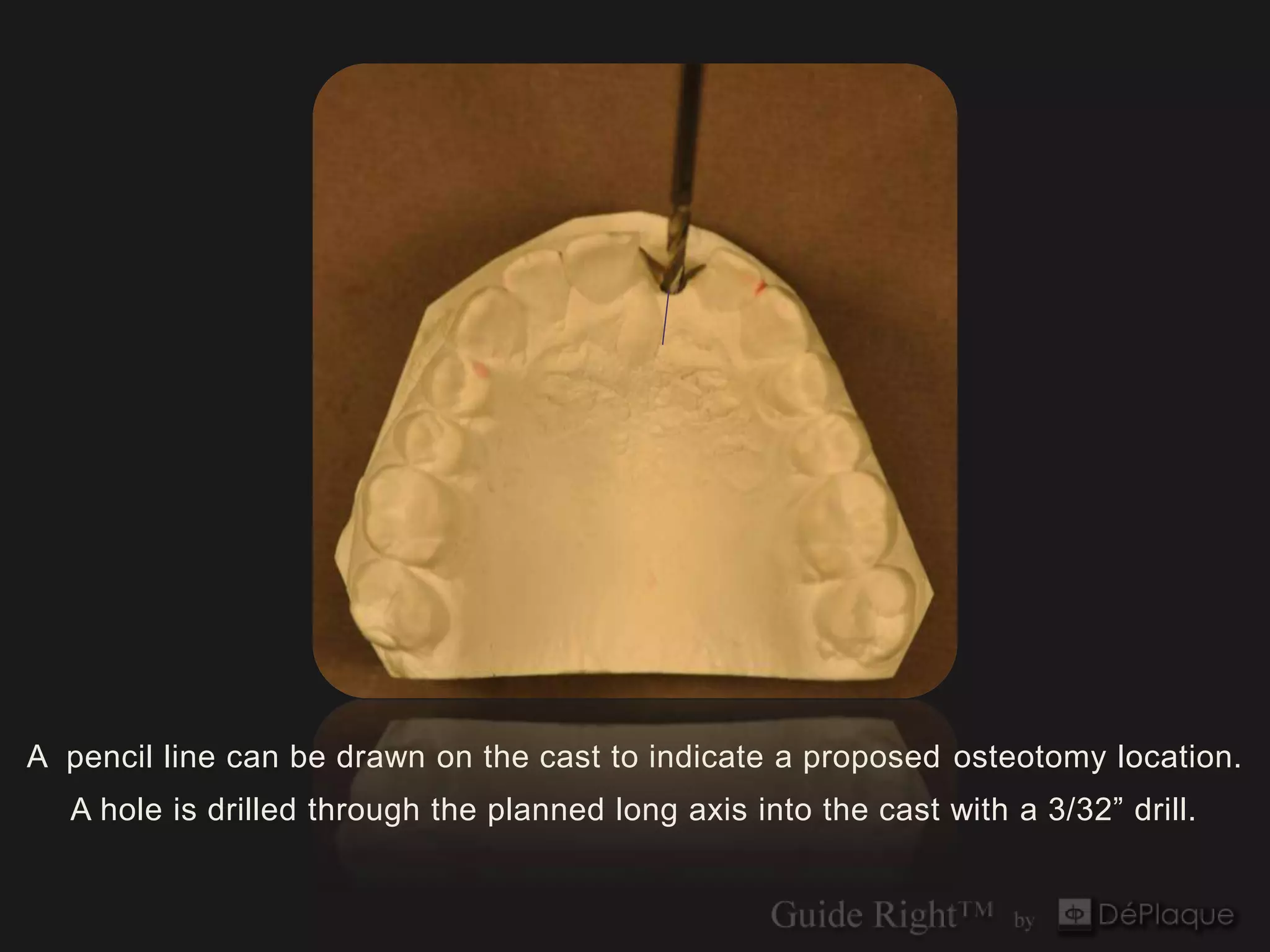 A pencil line can be drawn on the cast to indicate a proposed osteotomy location.
  A hole is drilled through the planned long axis into the cast with a 3/32” drill.
 