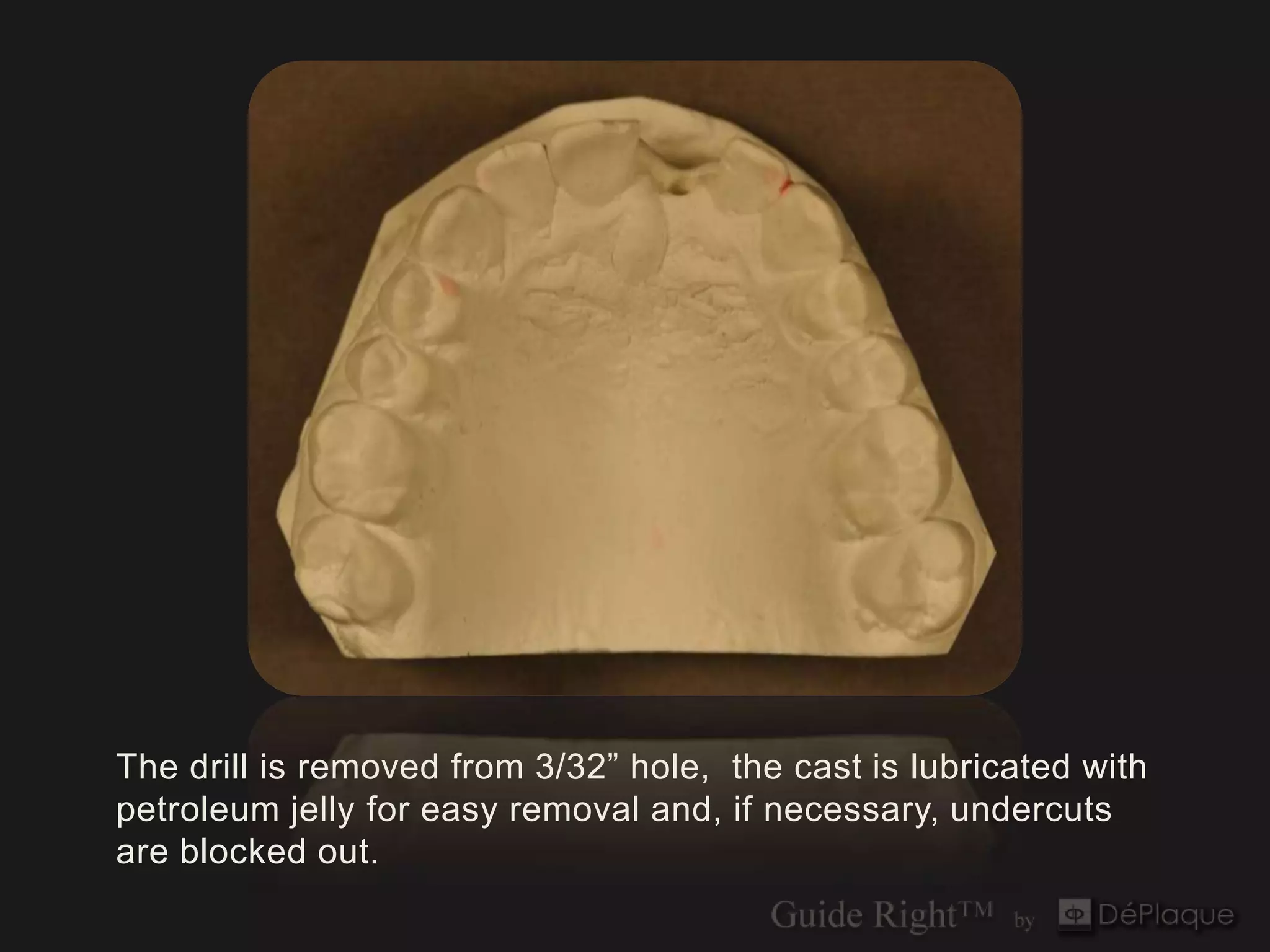 The drill is removed from 3/32” hole, the cast is lubricated with
petroleum jelly for easy removal and, if necessary, undercuts
are blocked out.
 