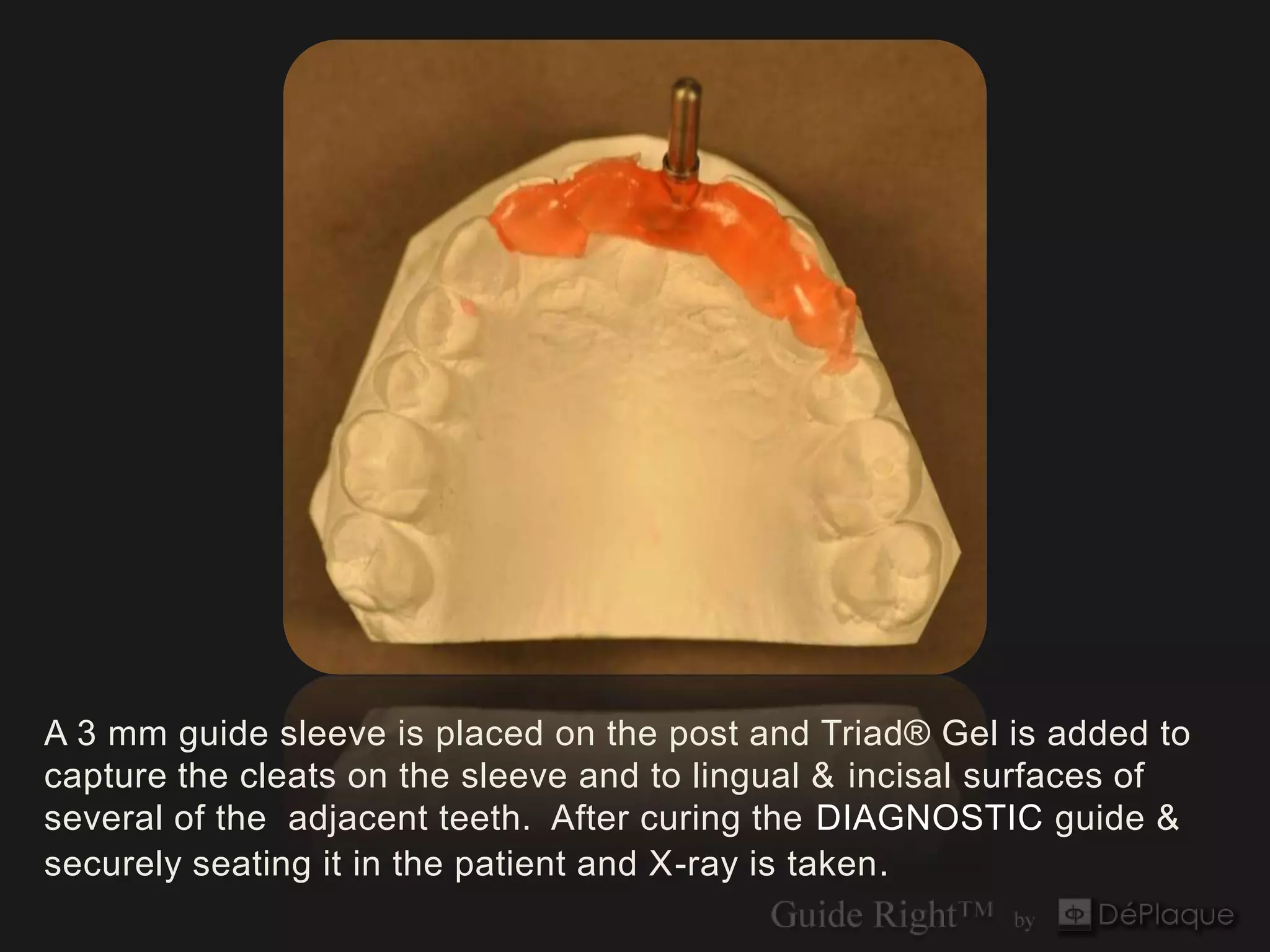 A 3 mm guide sleeve is placed on the post and Triad® Gel is added to
capture the cleats on the sleeve and to lingual & incisal surfaces of
several of the adjacent teeth. After curing the DIAGNOSTIC guide &
securely seating it in the patient and X-ray is taken .
 