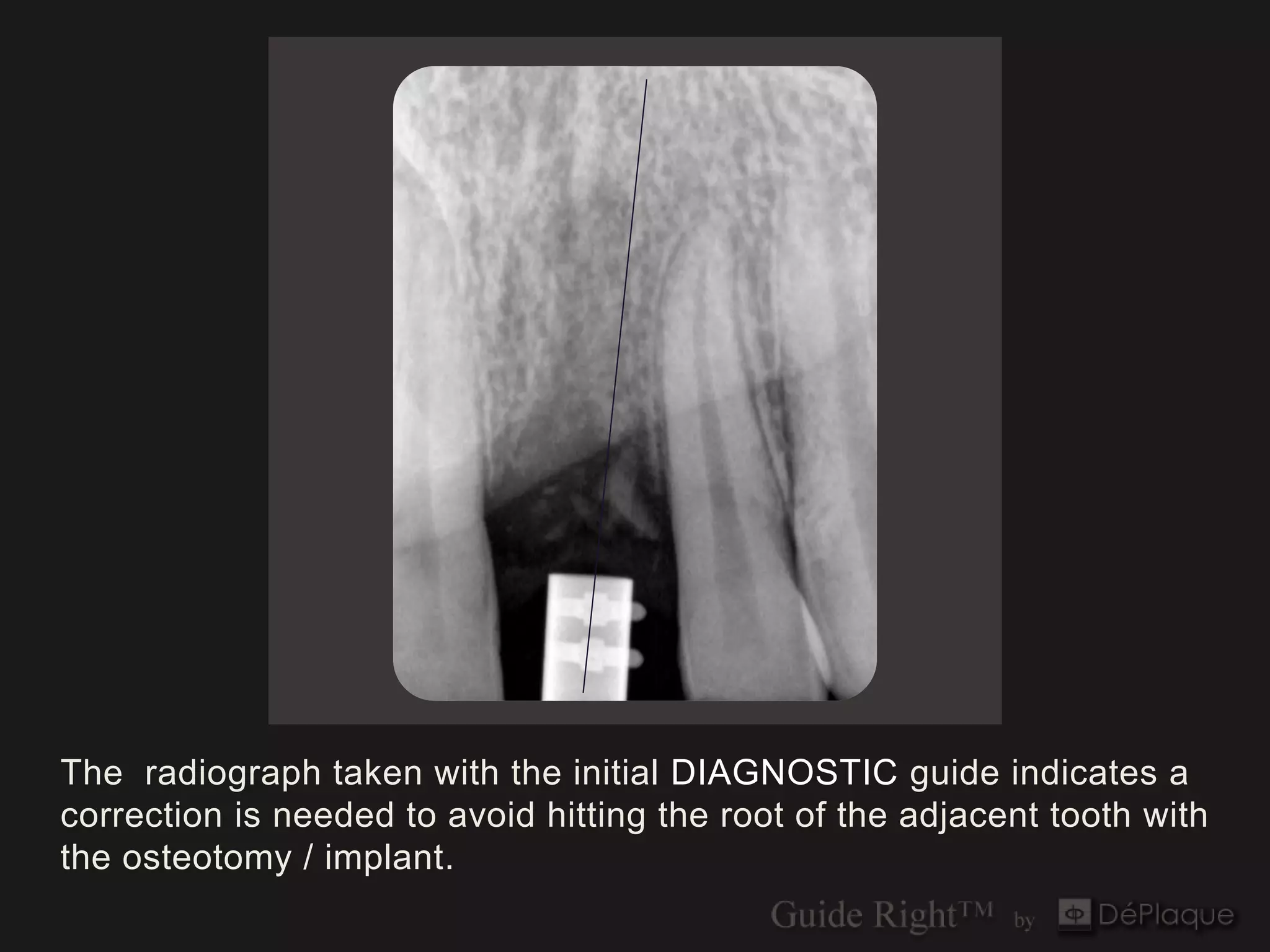 The radiograph taken with the initial DIAGNOSTIC guide indicates a
correction is needed to avoid hitting the root of the adjacent tooth with
the osteotomy / implant.
 