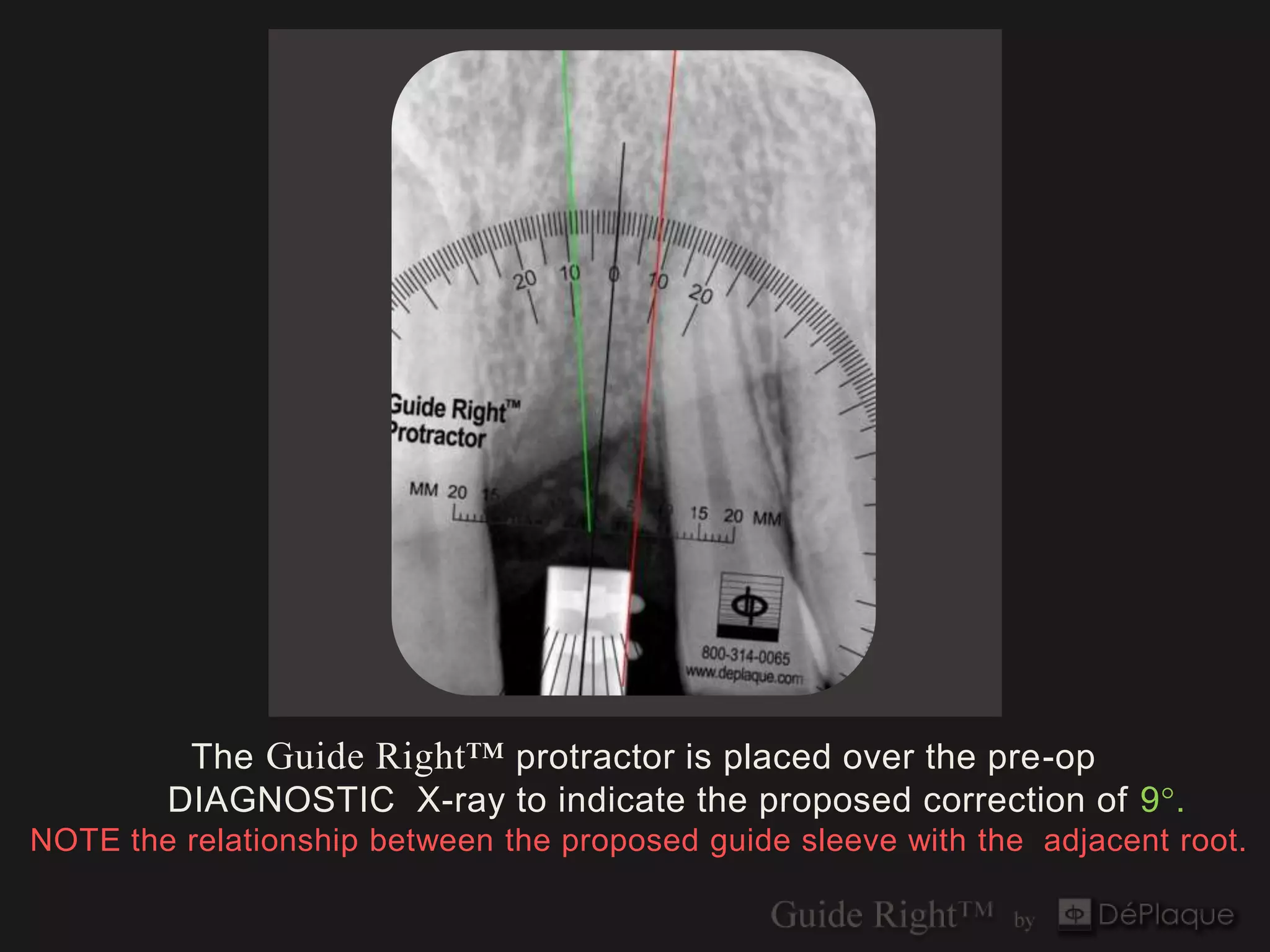 The Guide Right™ protractor is placed over the pre-op
        DIAGNOSTIC X-ray to indicate the proposed correction of 9°.
NOTE the relationship between the proposed guide sleeve with the adjacent root.
 