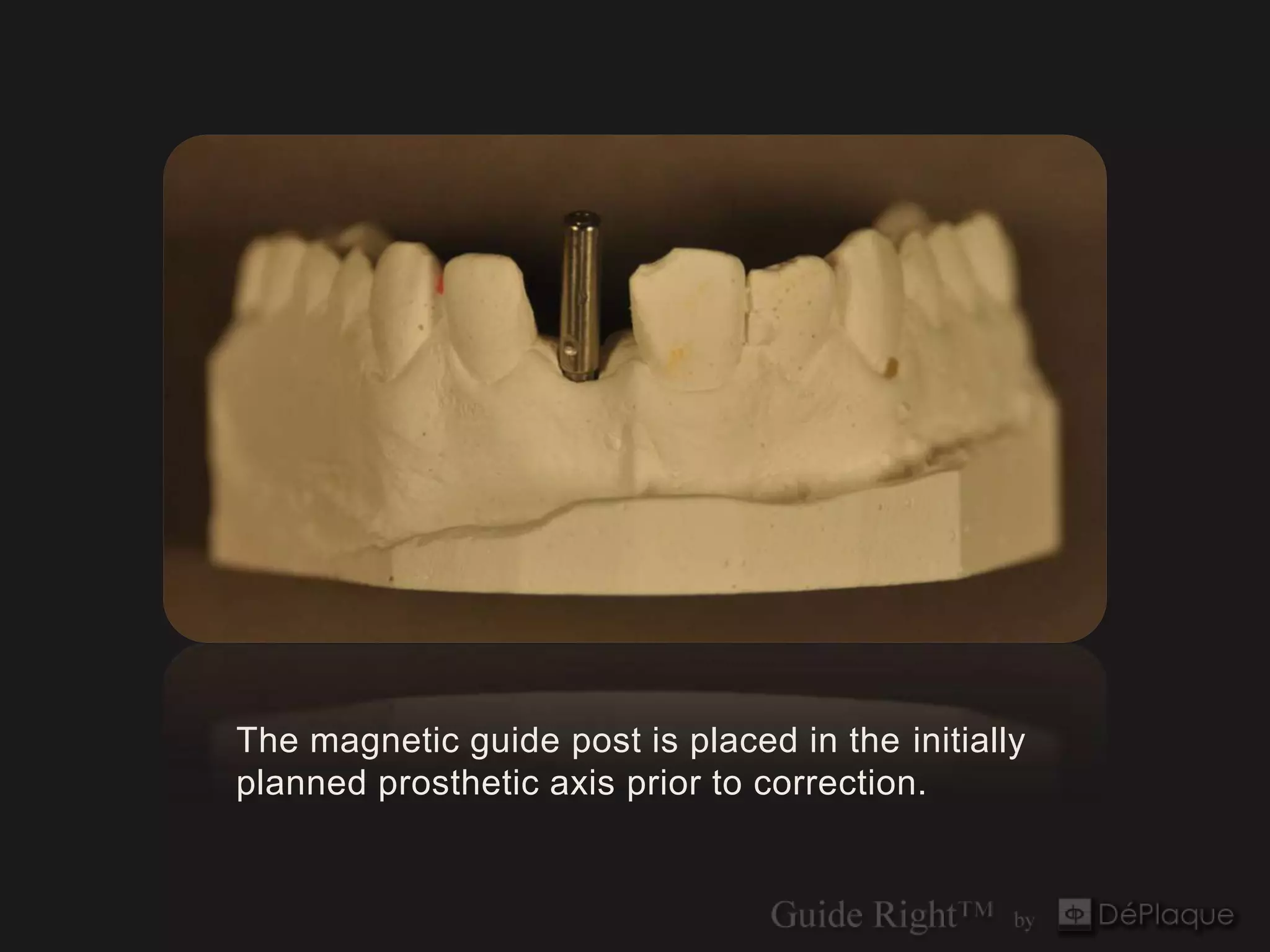 The magnetic guide post is placed in the initially
planned prosthetic axis prior to correction.
 