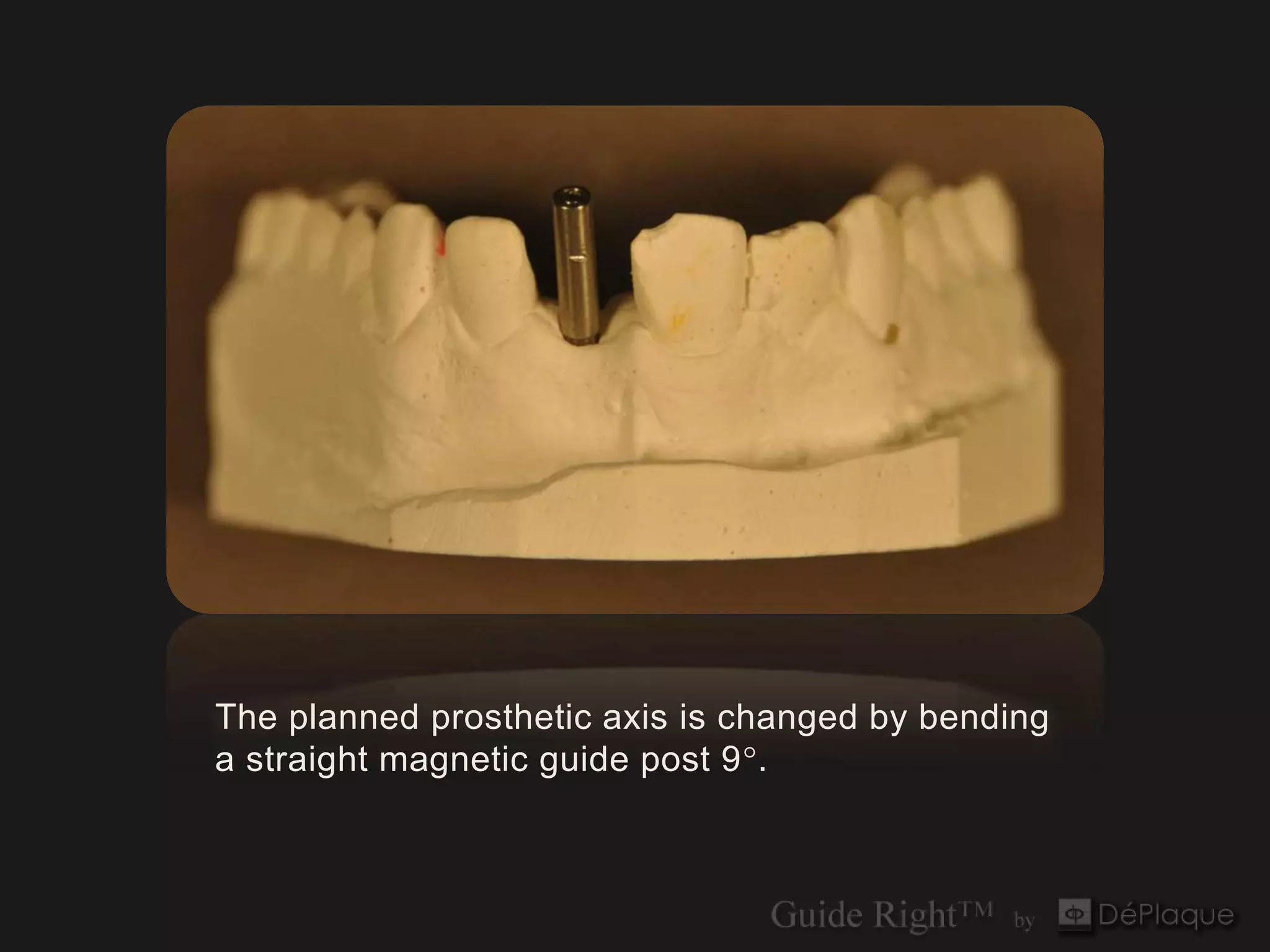 The planned prosthetic axis is changed by bending
a straight magnetic guide post 9°.
 
