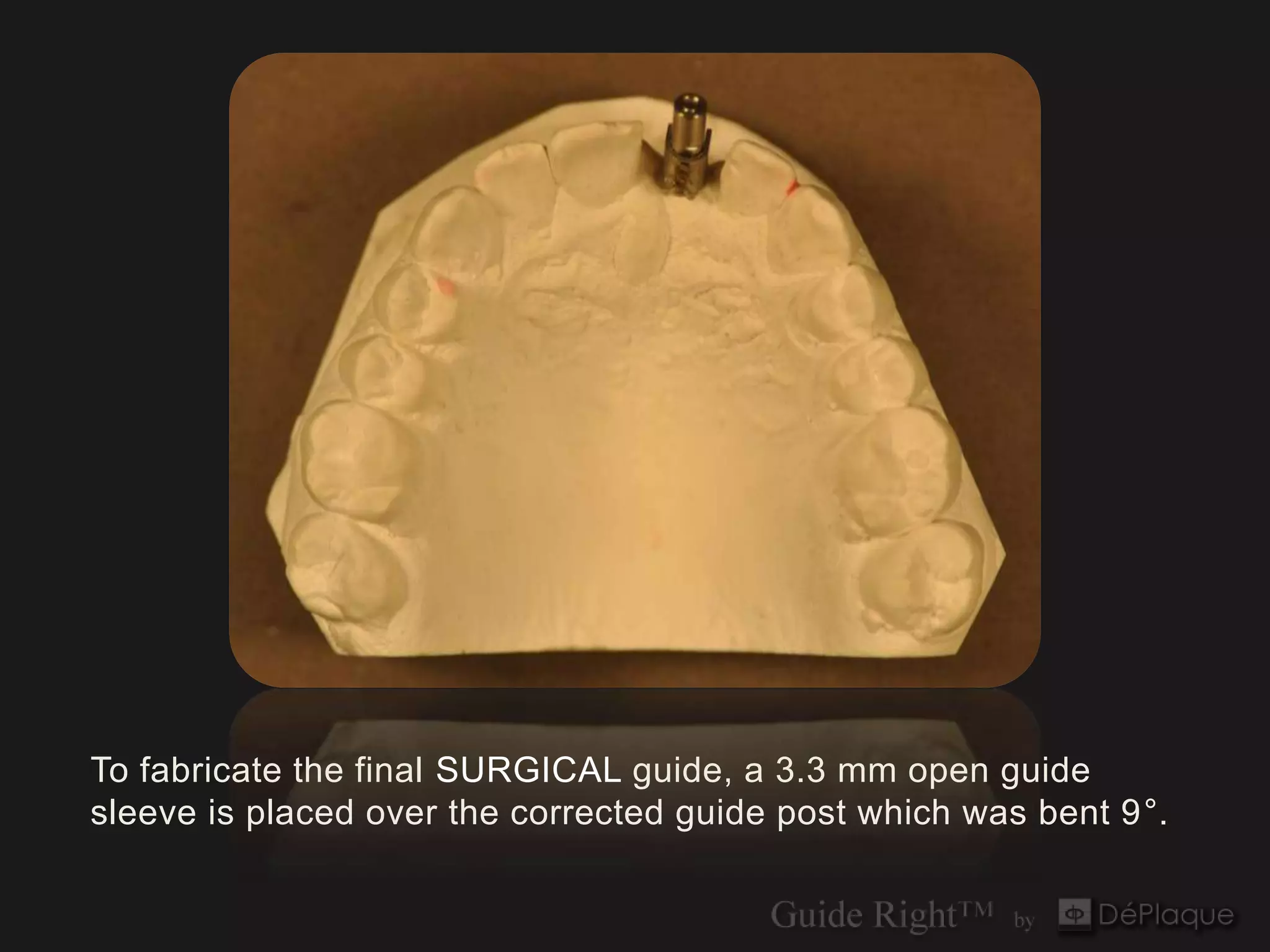 To fabricate the final SURGICAL guide, a 3.3 mm open guide
sleeve is placed over the corrected guide post which was bent 9°.
 