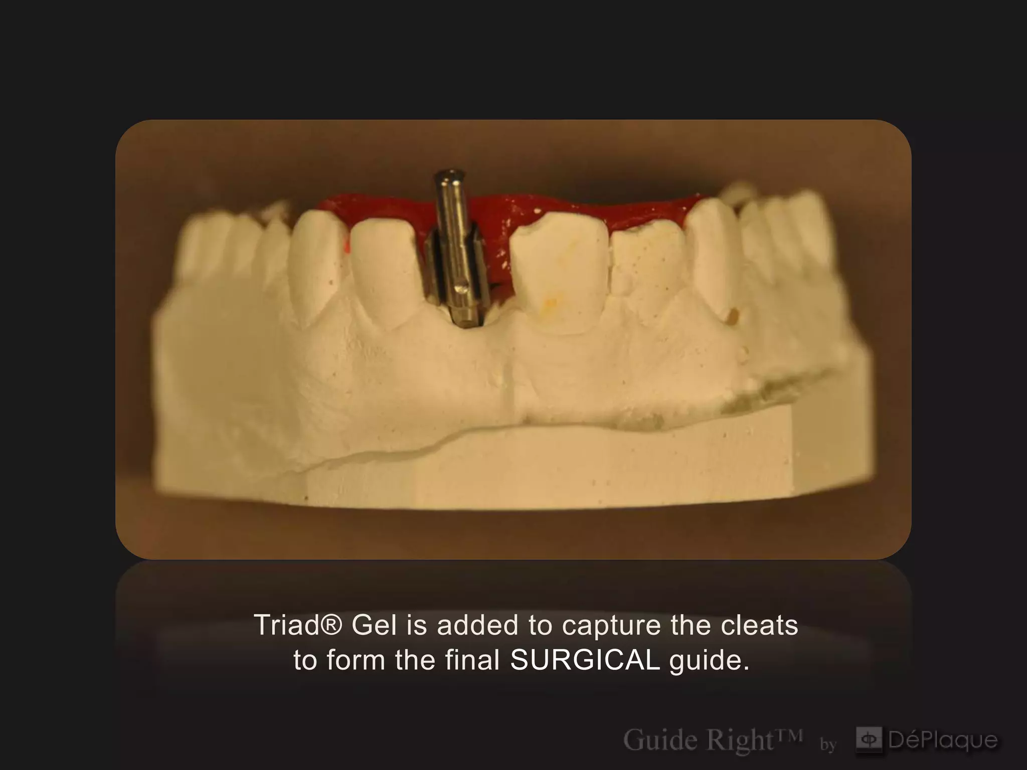 Triad® Gel is added to capture the cleats
   to form the final SURGICAL guide.
 