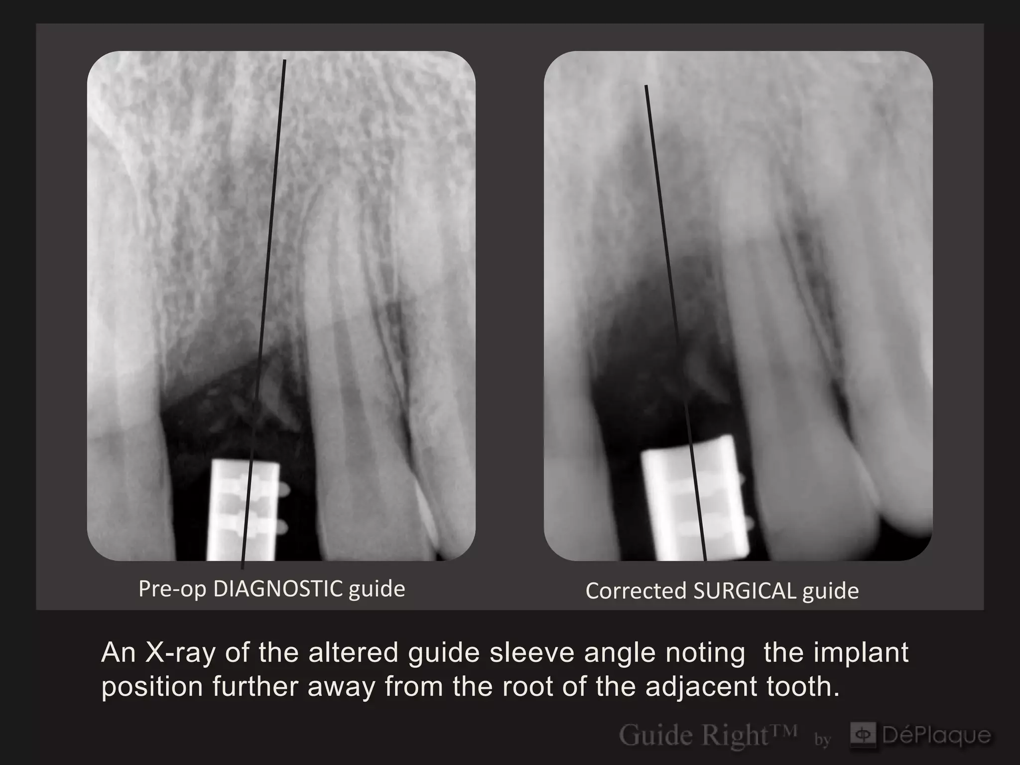 Pre-op DIAGNOSTIC guide           Corrected SURGICAL guide

An X-ray of the altered guide sleeve angle noting the implant
position further away from the root of the adjacent tooth.
 