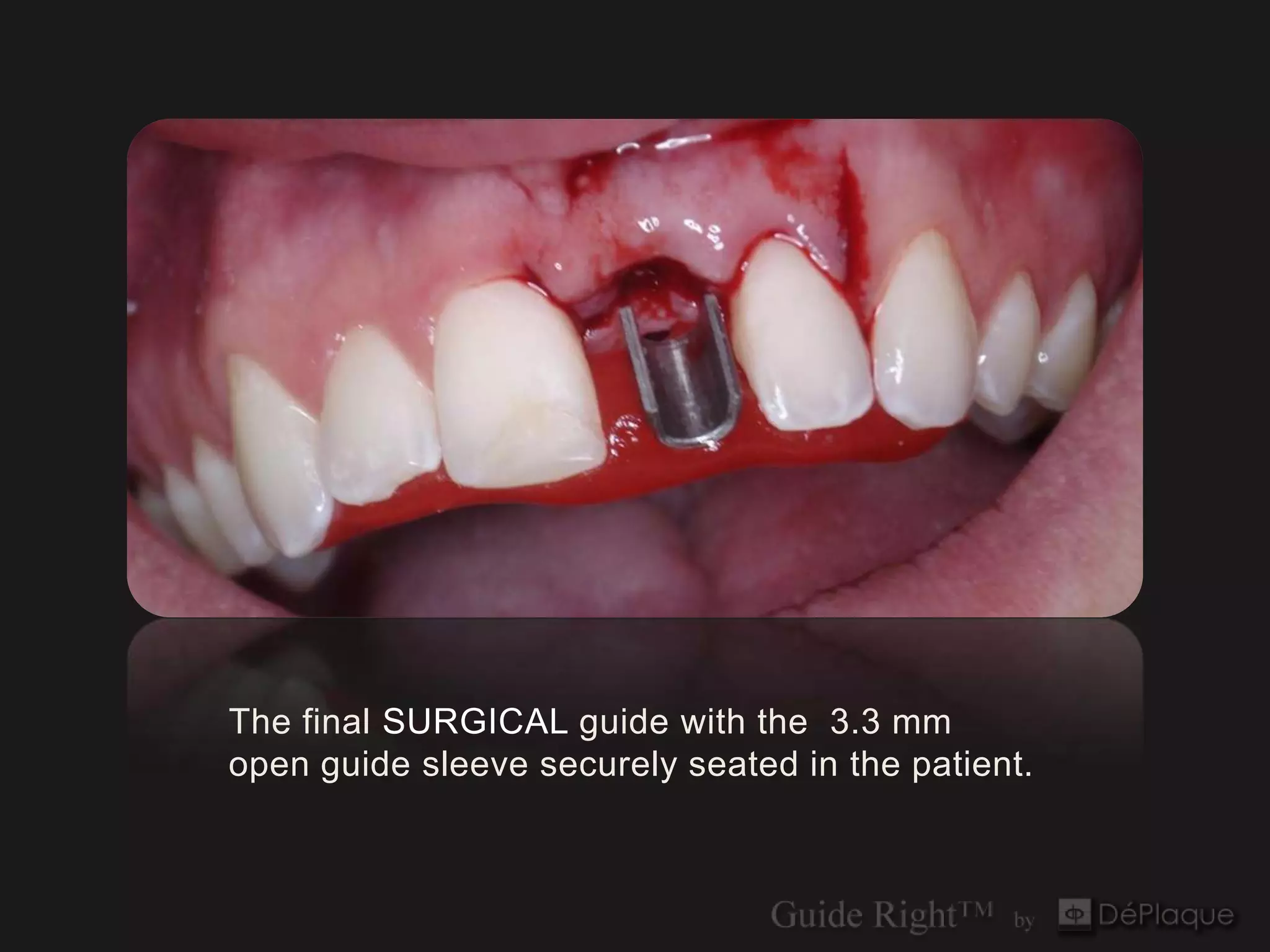 The final SURGICAL guide with the 3.3 mm
open guide sleeve securely seated in the patient.
 