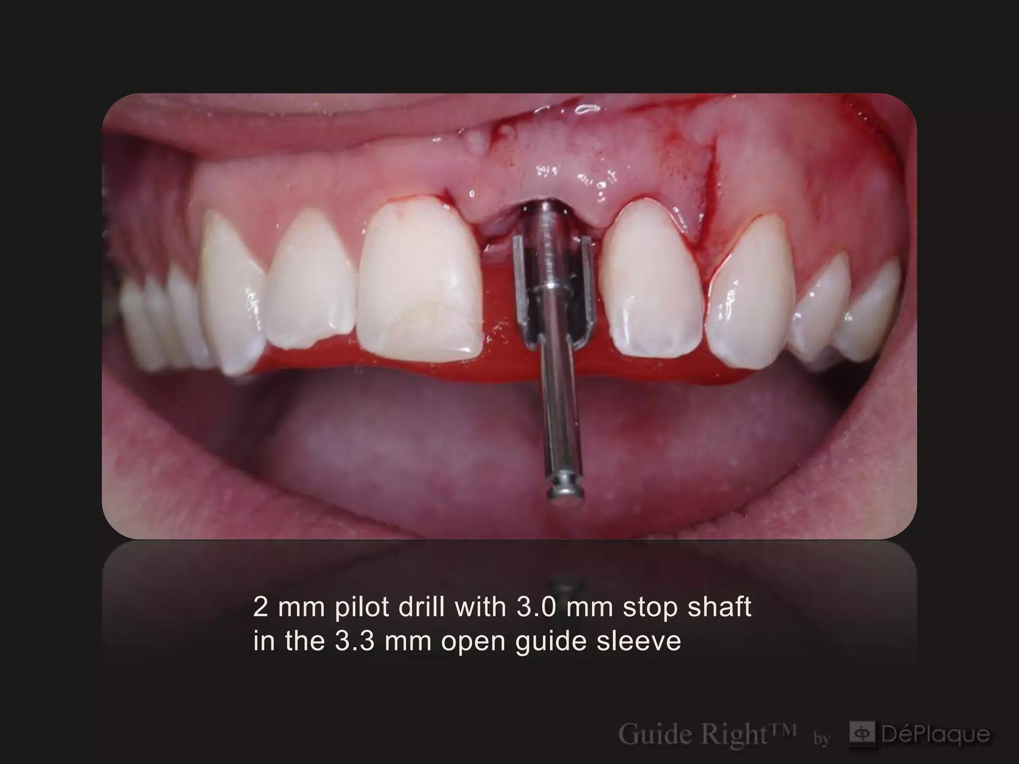 2 mm pilot drill with 3.0 mm stop shaft
in the 3.3 mm open guide sleeve
 