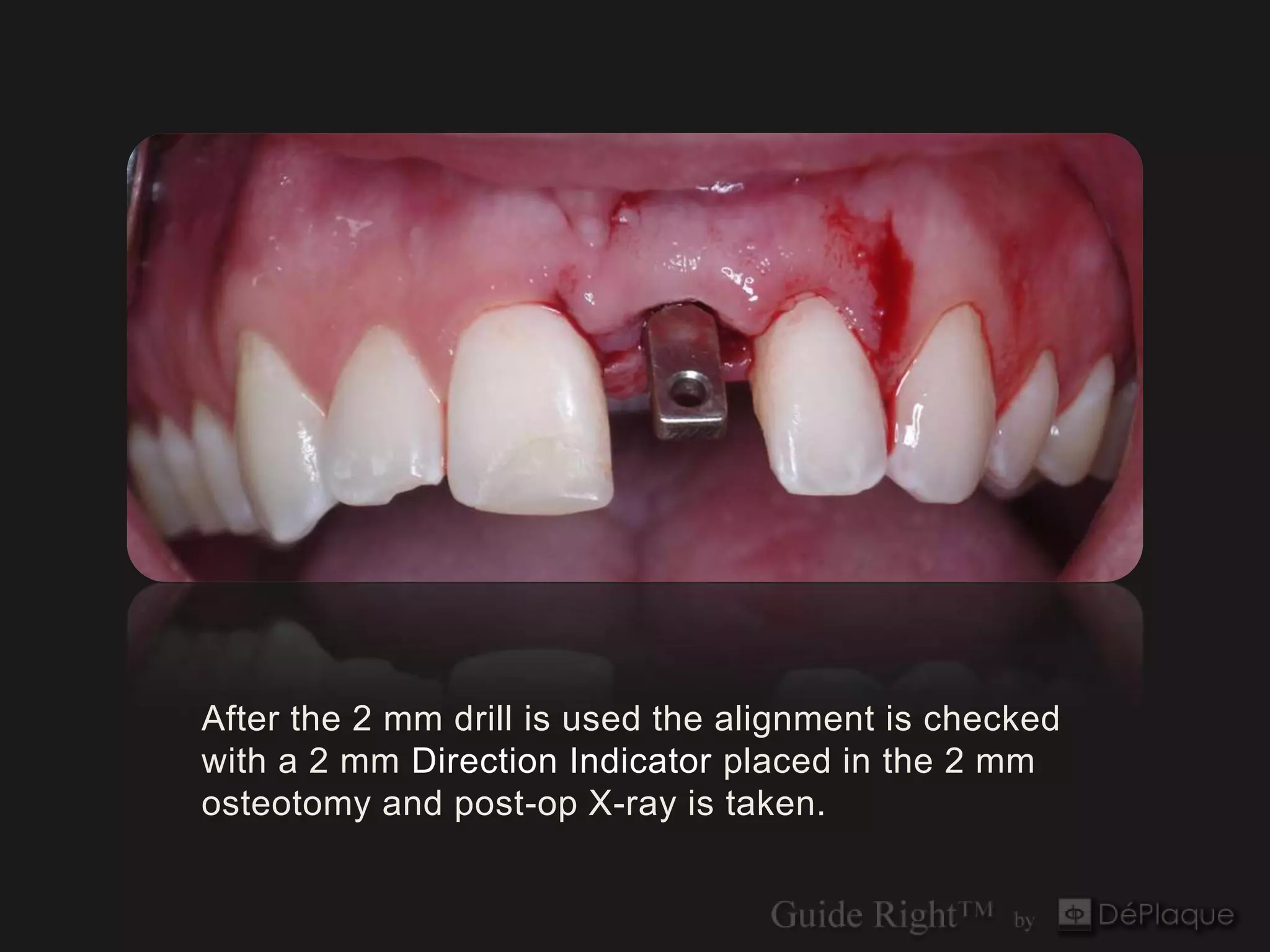 After the 2 mm drill is used the alignment is checked
with a 2 mm Direction Indicator placed in the 2 mm
osteotomy and post-op X-ray is taken.
 