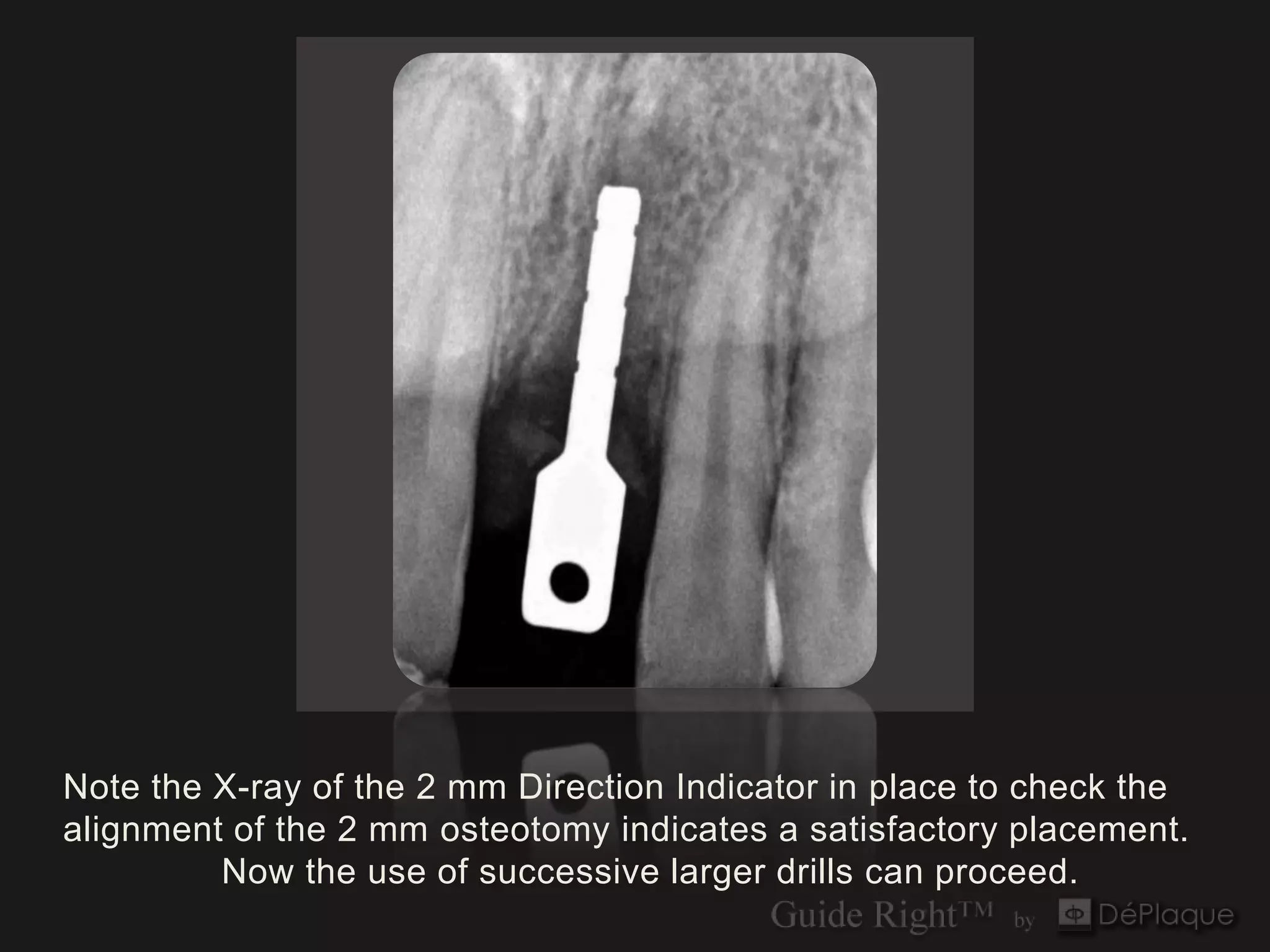 Note the X-ray of the 2 mm Direction Indicator in place to check the
alignment of the 2 mm osteotomy indicates a satisfactory placement.
         Now the use of successive larger drills can proceed.
 