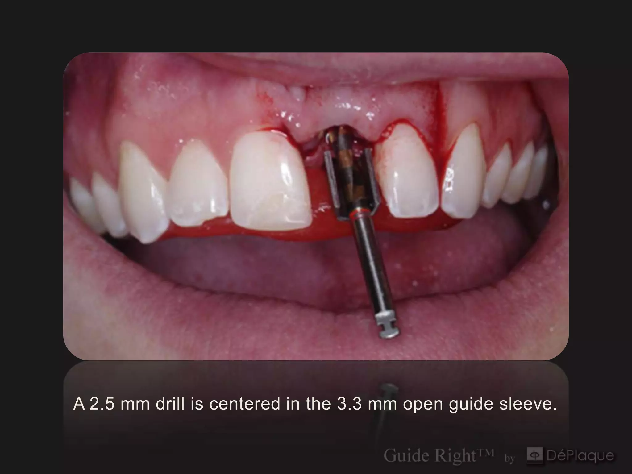 A 2.5 mm drill is centered in the 3.3 mm open guide sleeve.
 