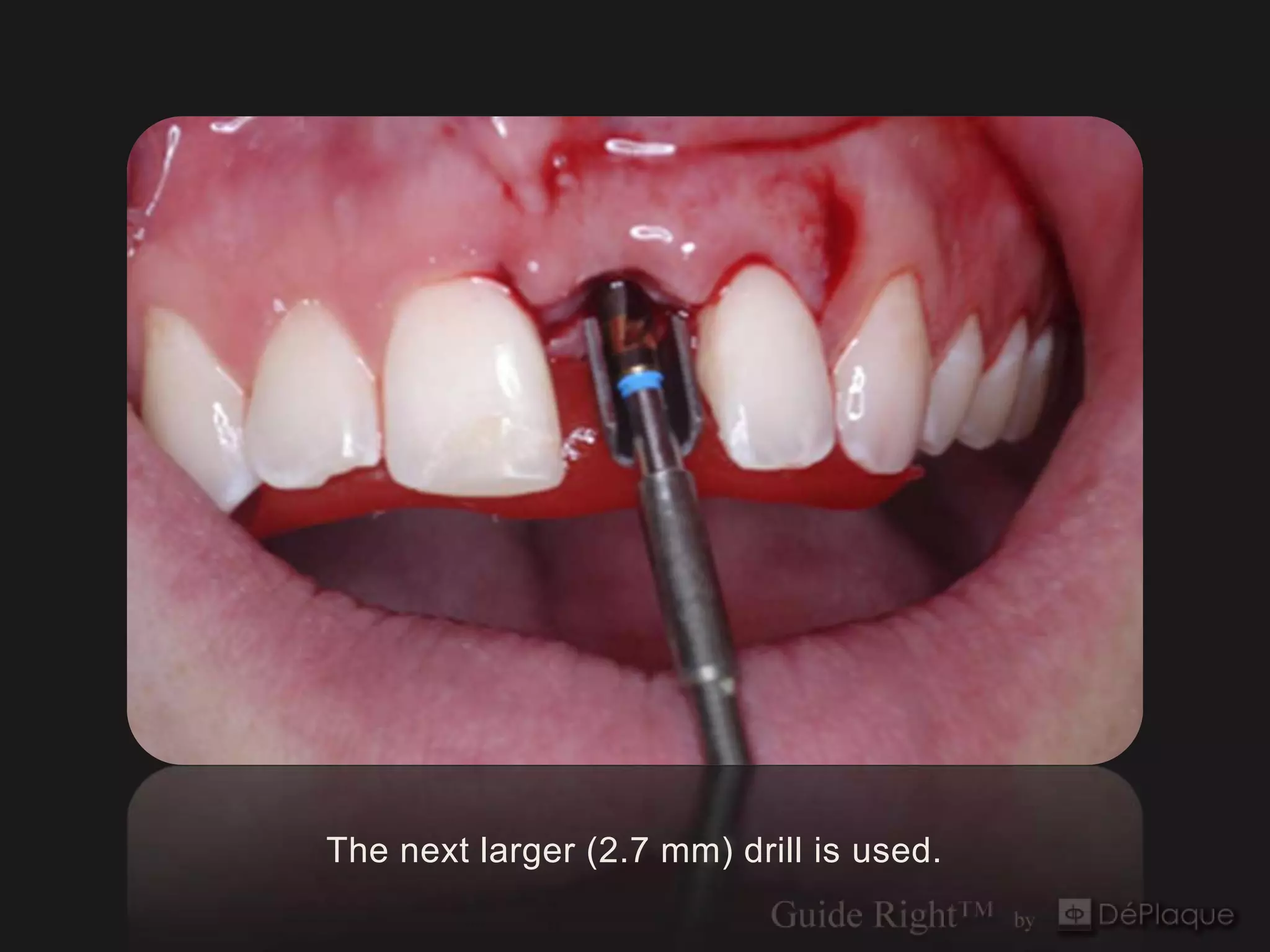 The next larger (2.7 mm) drill is used.
 