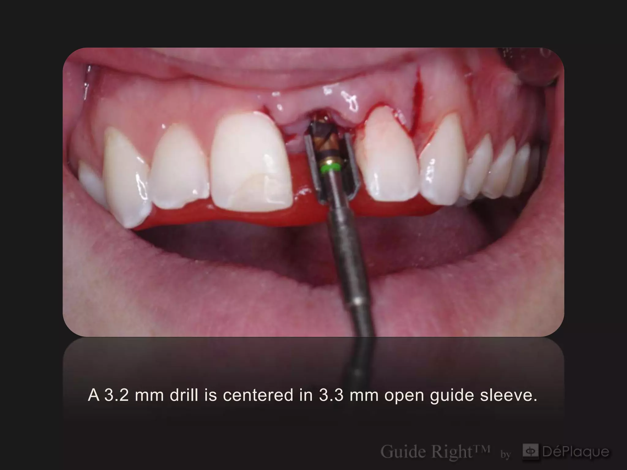 A 3.2 mm drill is centered in 3.3 mm open guide sleeve.
 