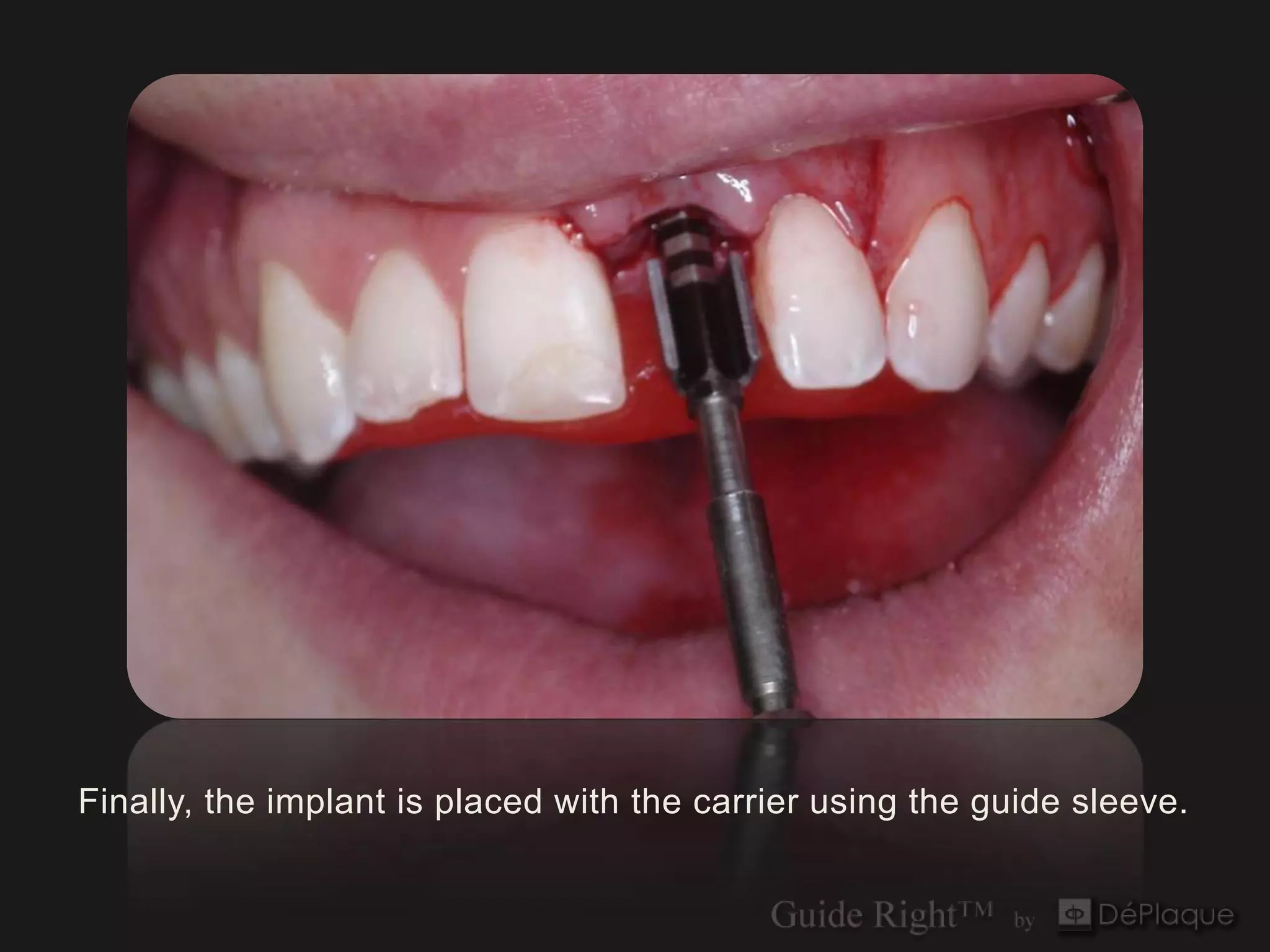 Finally, the implant is placed with the carrier using the guide sleeve.
 