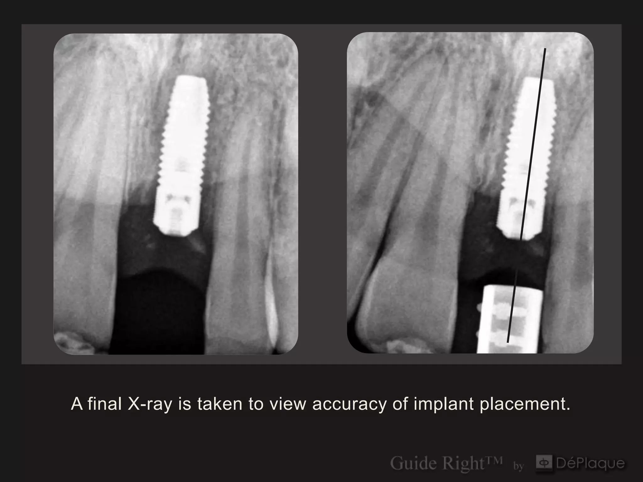 A final X-ray is taken to view accuracy of implant placement.
 