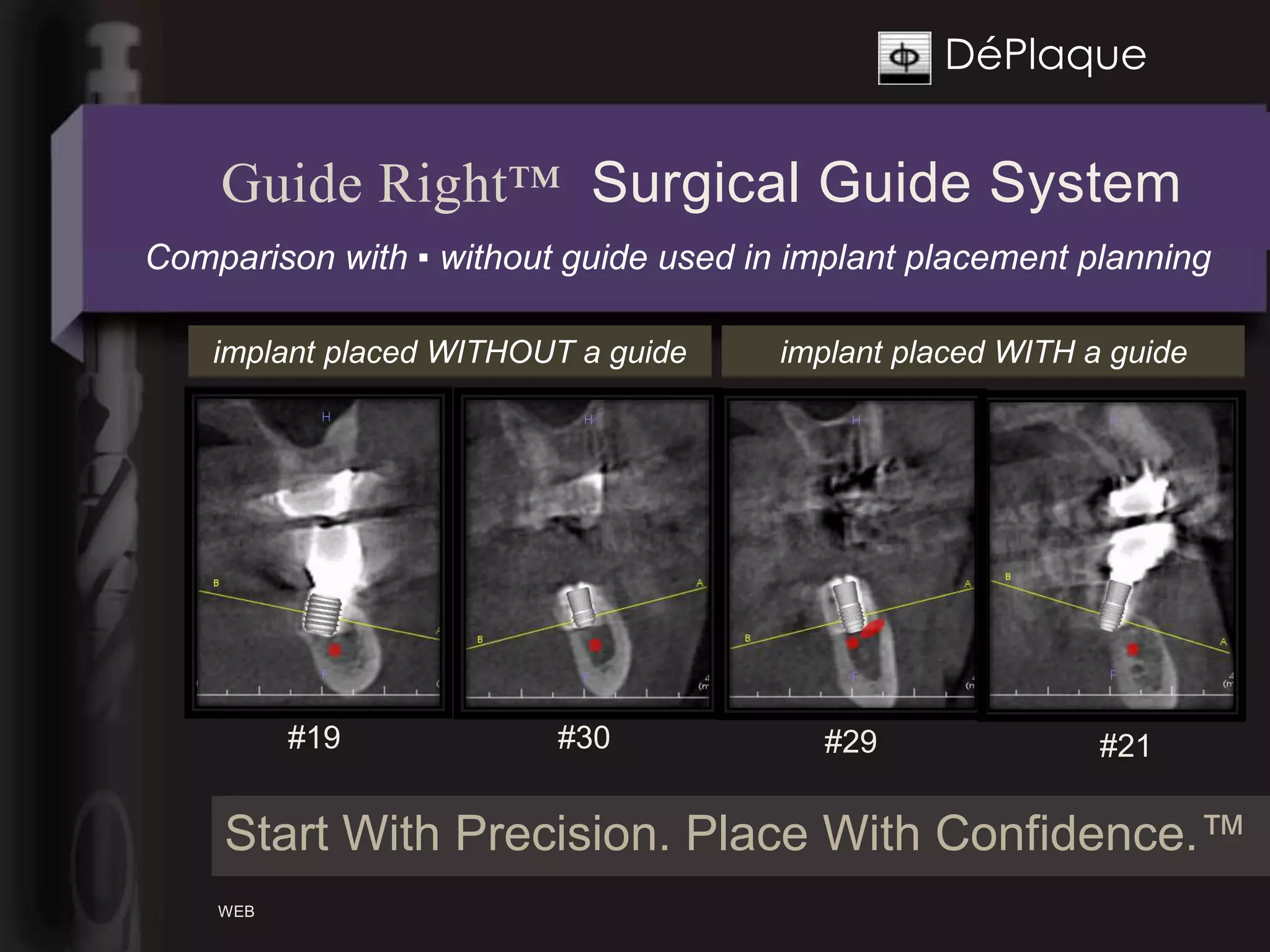 DéPlaque


    Guide Right™ Surgical Guide System
Comparison with ▪ without guide used in implant placement planning

    implant placed WITHOUT a guide     implant placed WITH a guide




          #19            #30              #29               #21

    Start With Precision. Place With Confidence.™
    WEB
 