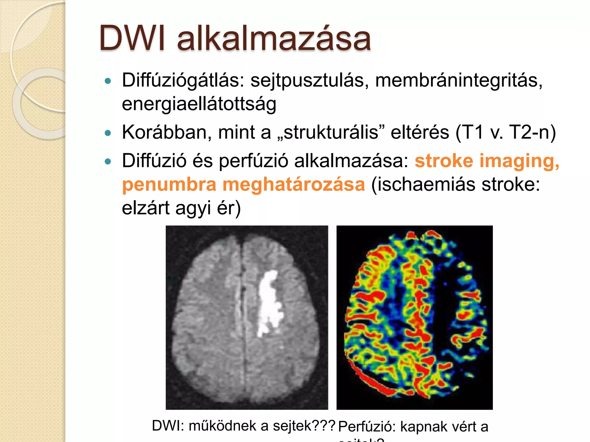 DWI alkalmazása
 Diffúziógátlás: sejtpusztulás, membránintegritás,
energiaellátottság
 Korábban, mint a „strukturális” eltérés (T1 v. T2-n)
 Diffúzió és perfúzió alkalmazása: stroke imaging,
penumbra meghatározása (ischaemiás stroke:
elzárt agyi ér)
DWI: működnek a sejtek???Perfúzió: kapnak vért a
 
