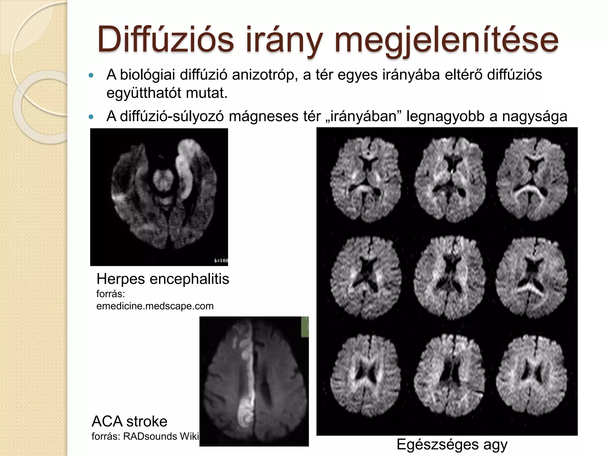 Diffúziós irány megjelenítése
 A biológiai diffúzió anizotróp, a tér egyes irányába eltérő diffúziós
együtthatót mutat.
 A diffúzió-súlyozó mágneses tér „irányában” legnagyobb a nagysága
Herpes encephalitis
forrás:
emedicine.medscape.com
Egészséges agy
ACA stroke
forrás: RADsounds Wiki
 