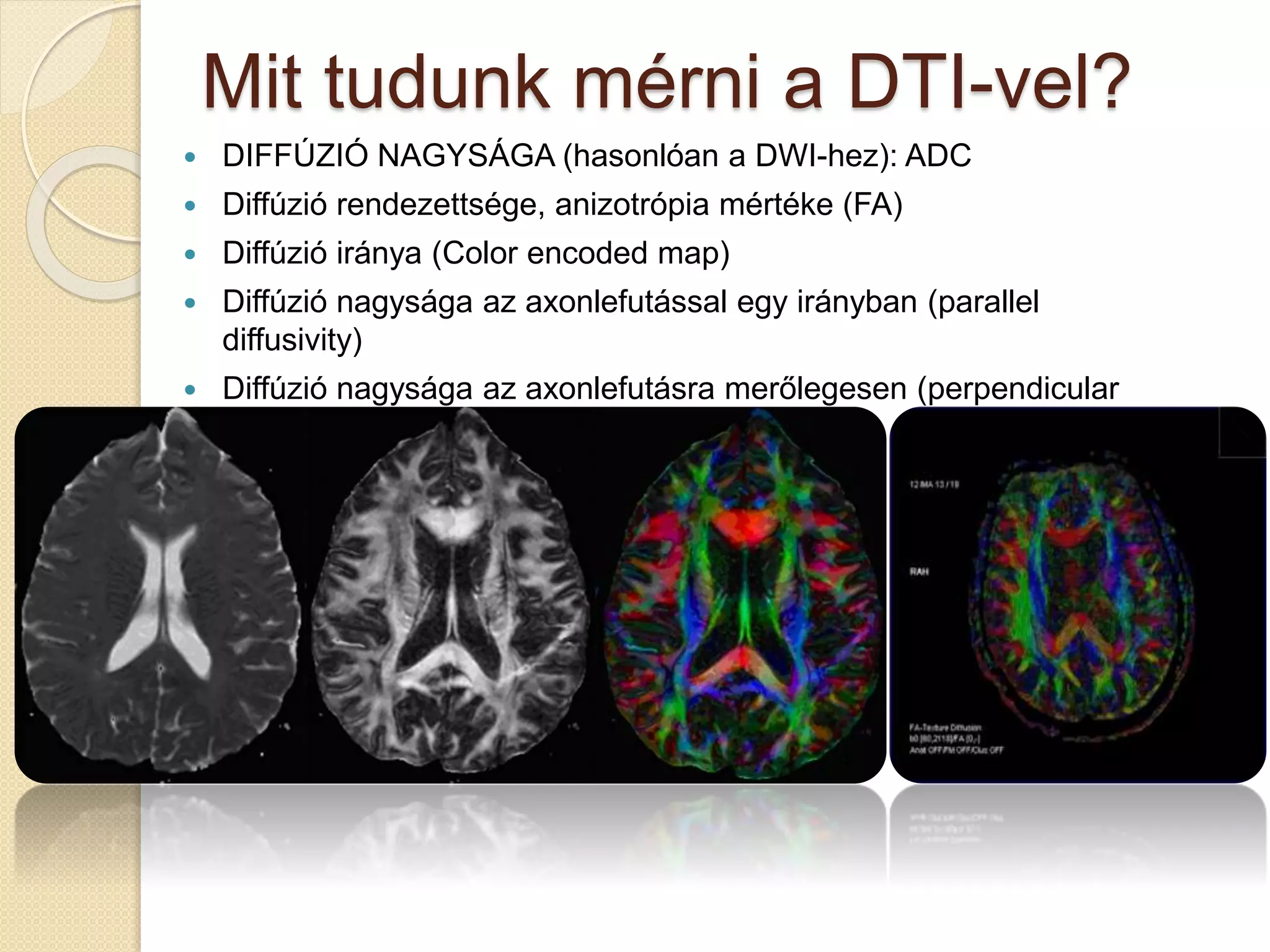 Mit tudunk mérni a DTI-vel?
 DIFFÚZIÓ NAGYSÁGA (hasonlóan a DWI-hez): ADC
 Diffúzió rendezettsége, anizotrópia mértéke (FA)
 Diffúzió iránya (Color encoded map)
 Diffúzió nagysága az axonlefutással egy irányban (parallel
diffusivity)
 Diffúzió nagysága az axonlefutásra merőlegesen (perpendicular
diffusivity)
 