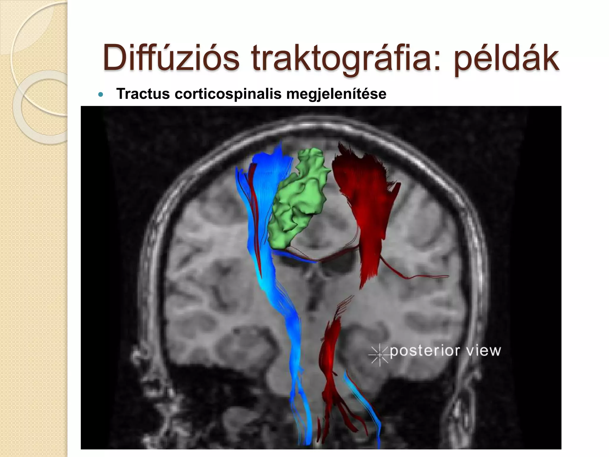 Diffúziós traktográfia: példák
 Tractus corticospinalis megjelenítése
 