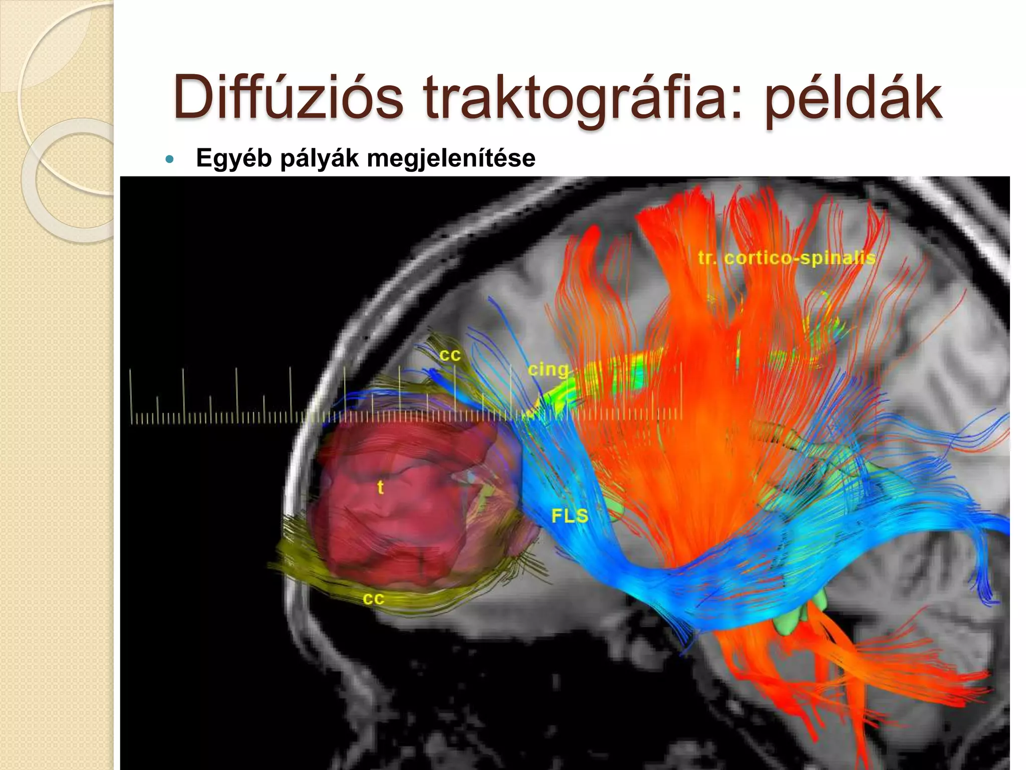 Diffúziós traktográfia: példák
 Egyéb pályák megjelenítése
 